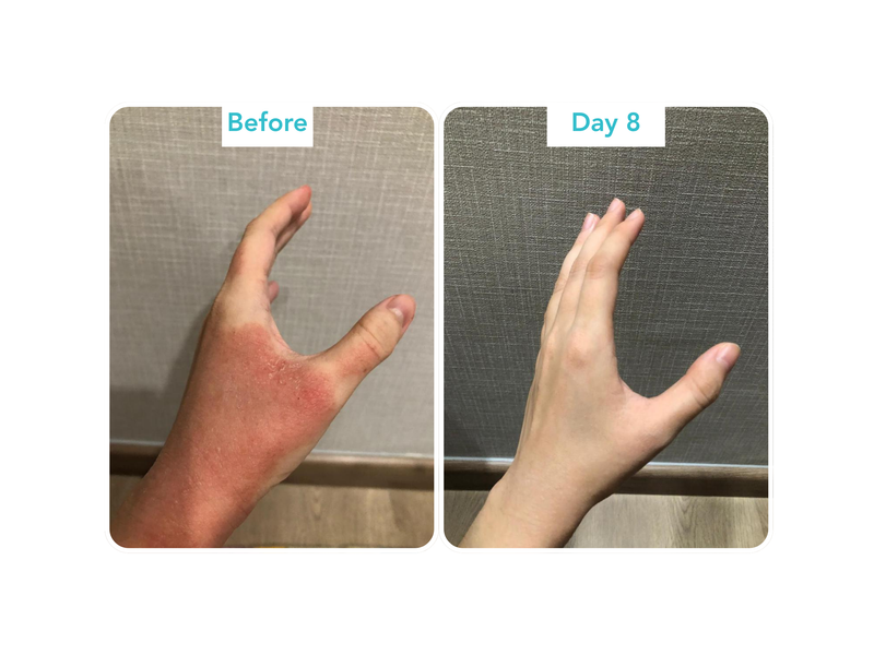 Eczema