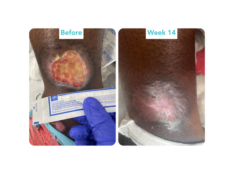 Leukocytoclastic Vasculitis