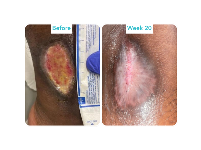 Leukocytoclastic Vasculitis