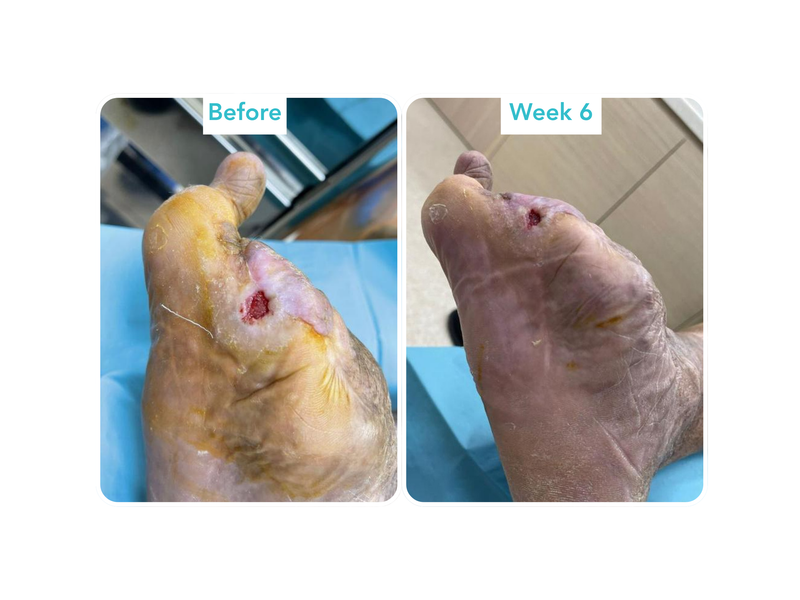 Diabetic Foot Ulcer