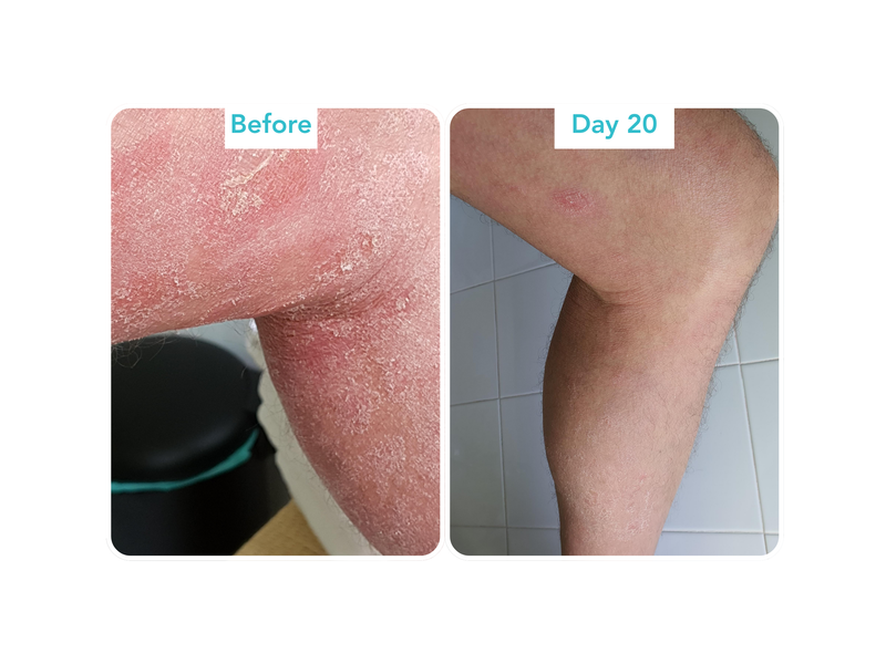 Topical Steroid Withdrawal