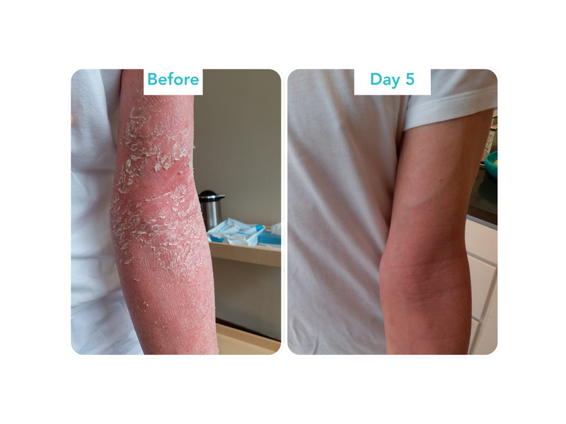 Topical Steroid Withdrawal