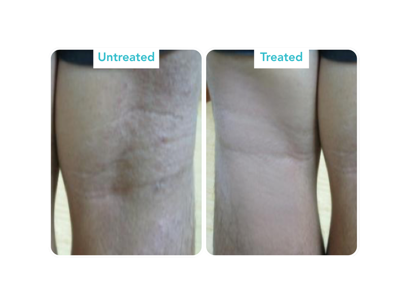 Eczema