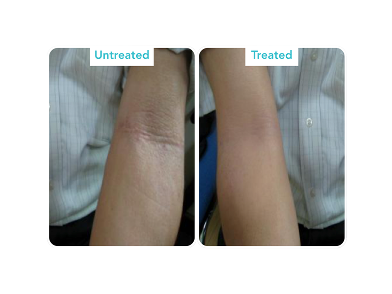 Eczema