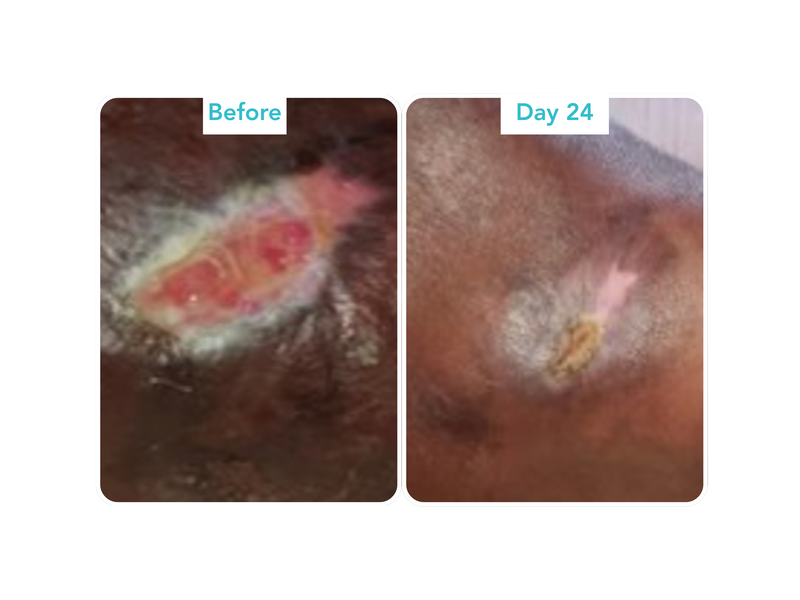Diabetic Foot Ulcer
