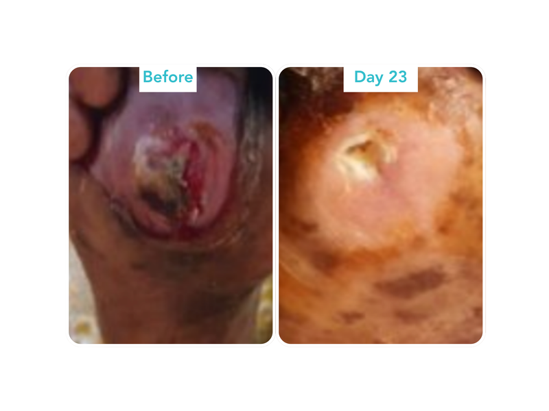 Diabetic Foot Ulcer