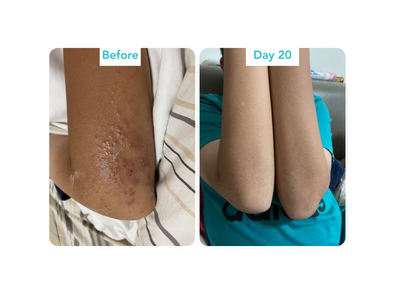 Topical Steroid Withdrawal