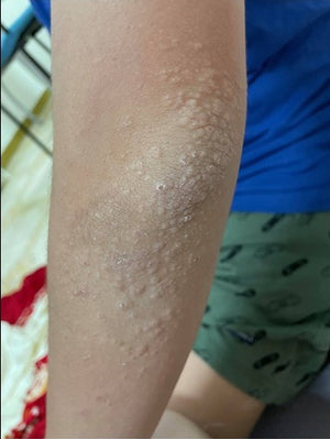 After 2 Days (Left Arm)