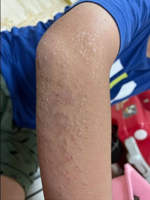 After 2 Days (Right Arm)