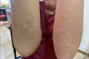 After 14 Days (Both Arms)