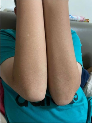 After 20 Days (Both Arms)