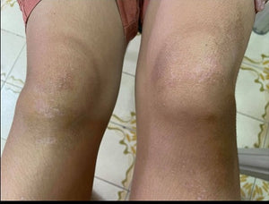 After 14 Days (Legs)