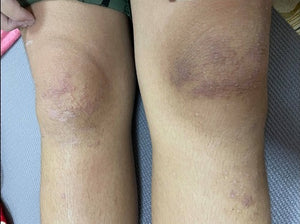 After 2 Days (Legs)